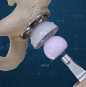人工髖關節g7 acetabular system